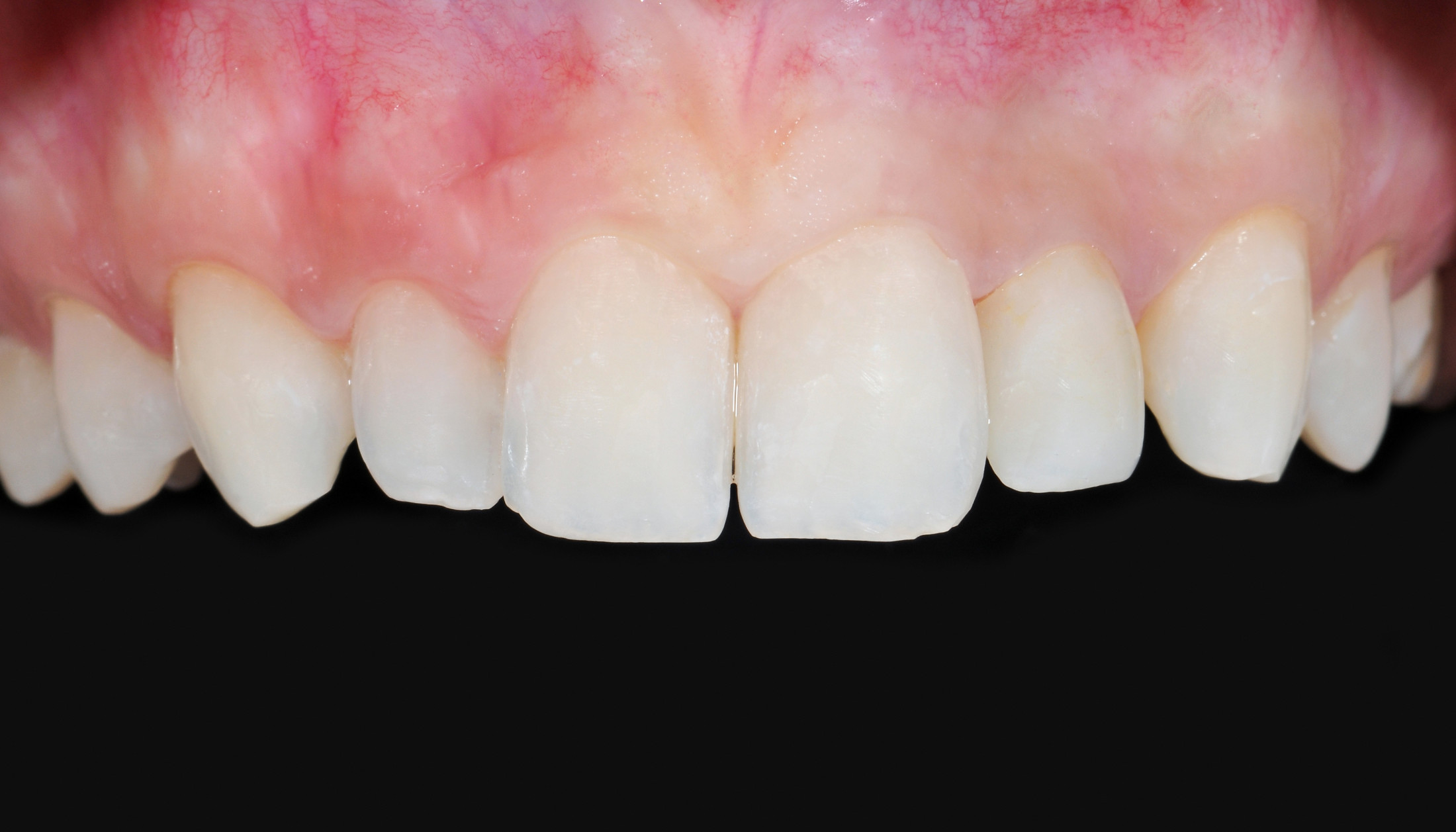 Keramik Zahnkrone Close up auf Zähne nachher