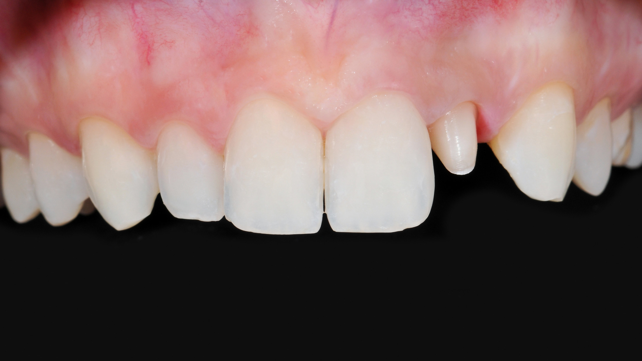 Keramik Zahnkrone – Close up auf Zähne vorher
