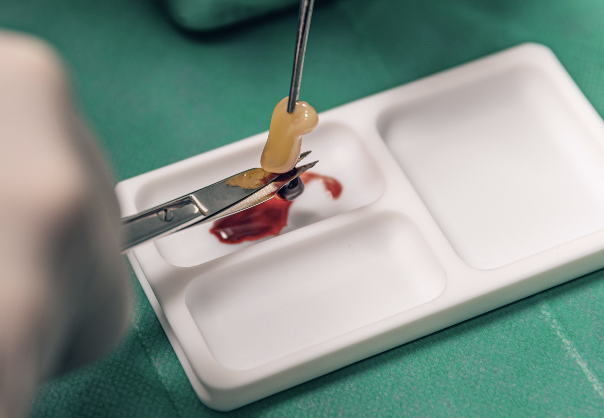 A-PRF Eigenblut Plasma A-PRF EIGENBLUTTHERAPIE - Kleines Plättchen auf weißem Tablett