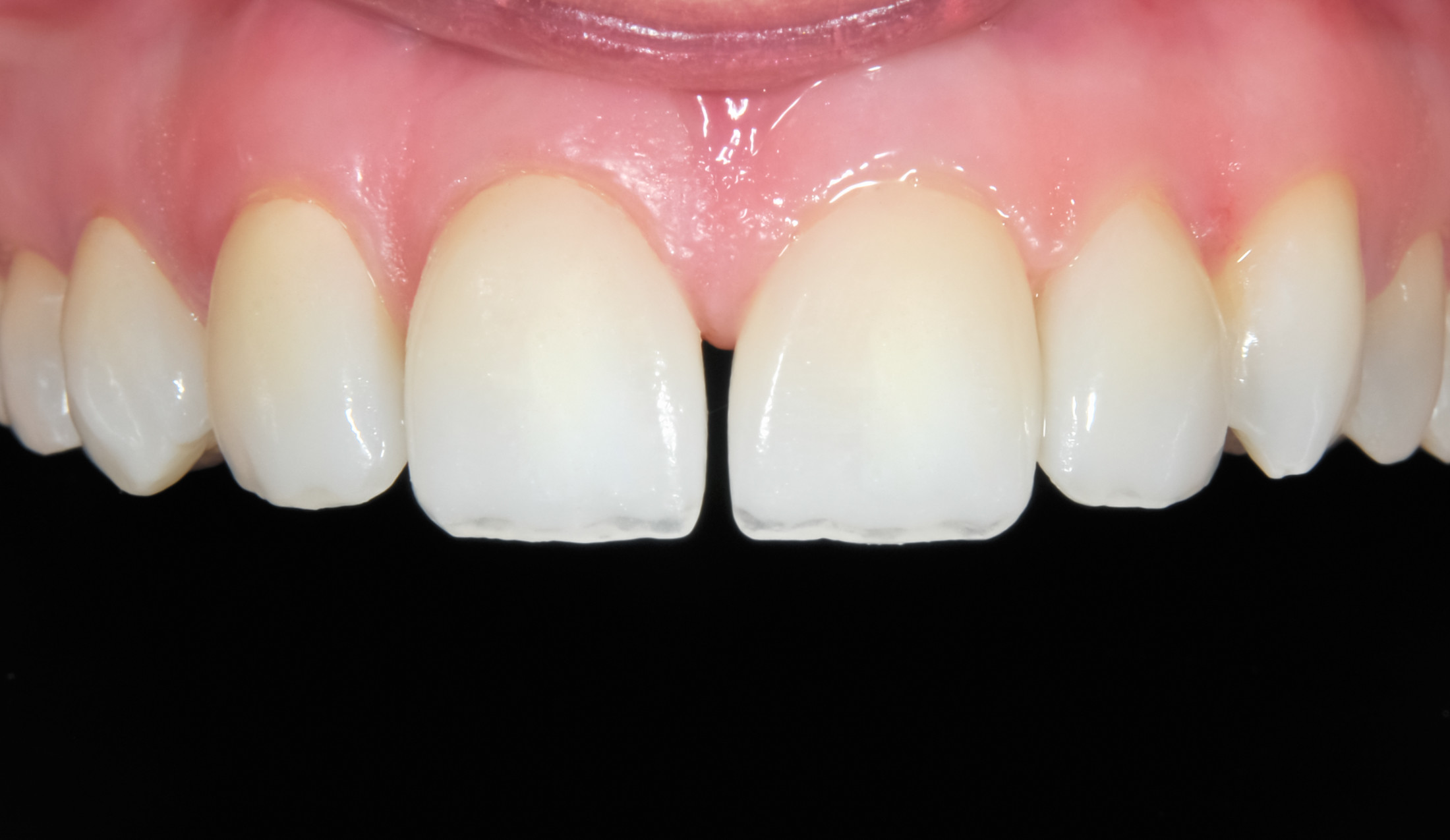 Nach der Aligner Behandlung