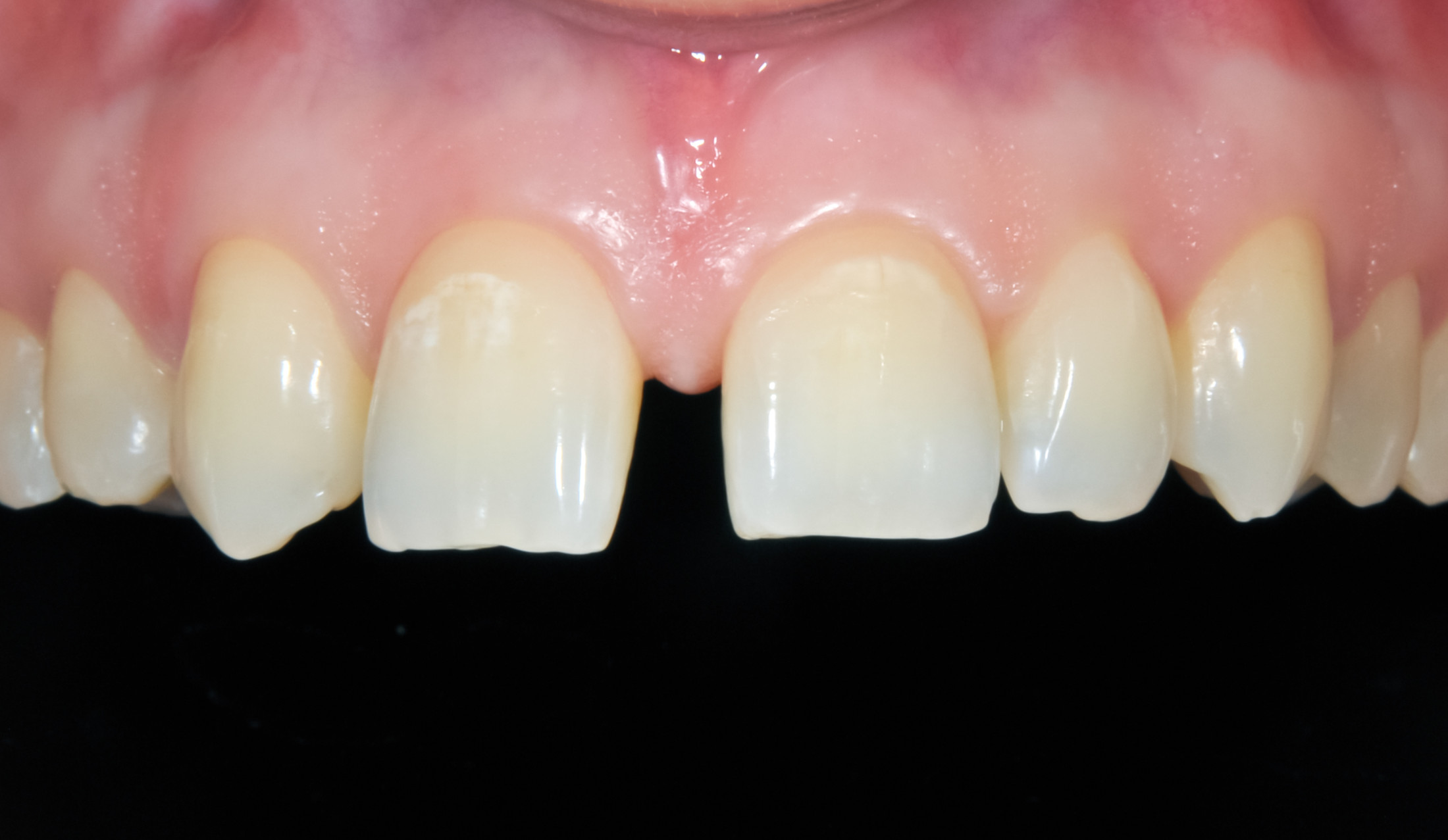 Aligner – vor der Behandlung einer Zahnlücke