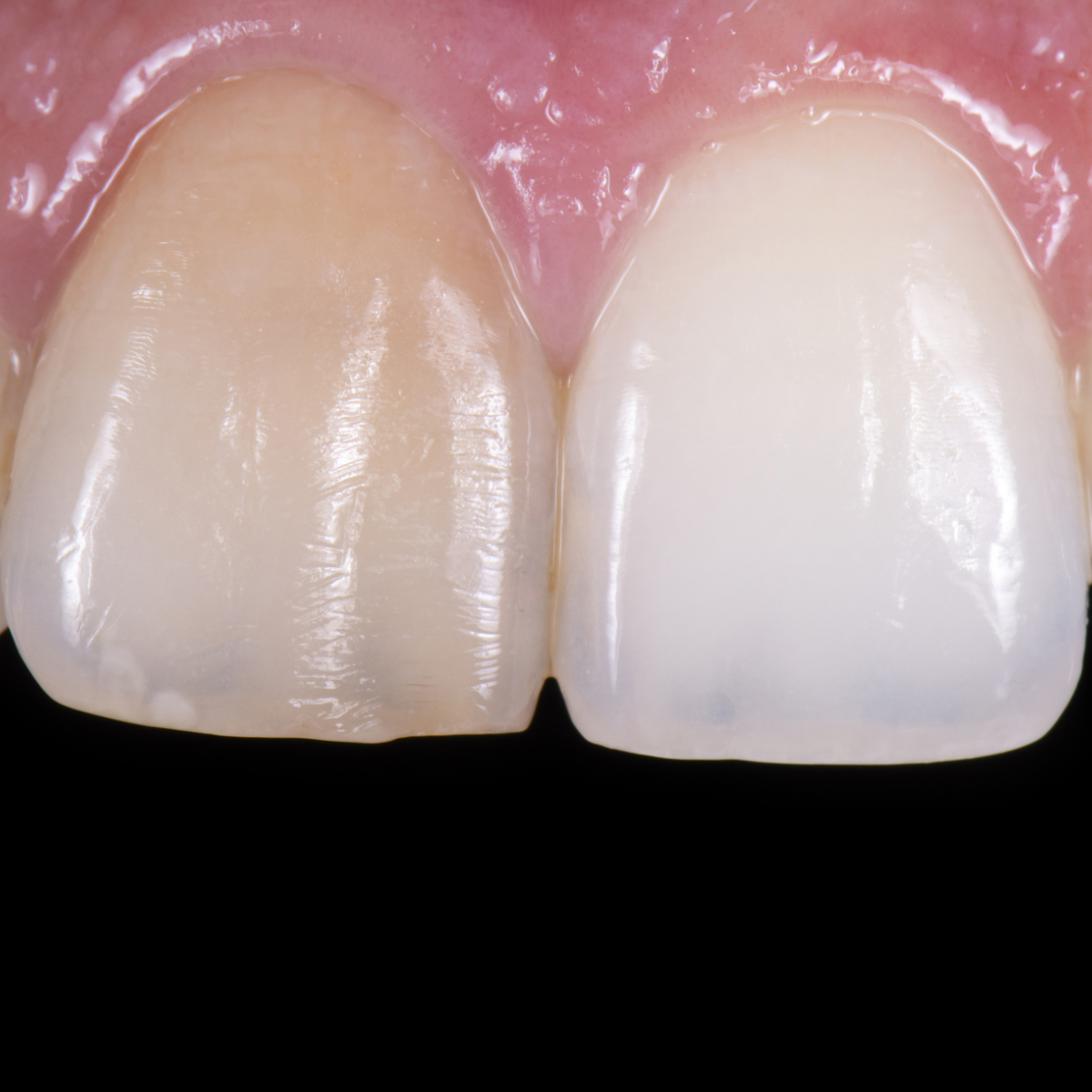 Frontzahn mit Verfärbung– vor der Versorgung mit einem Veneer im Close up