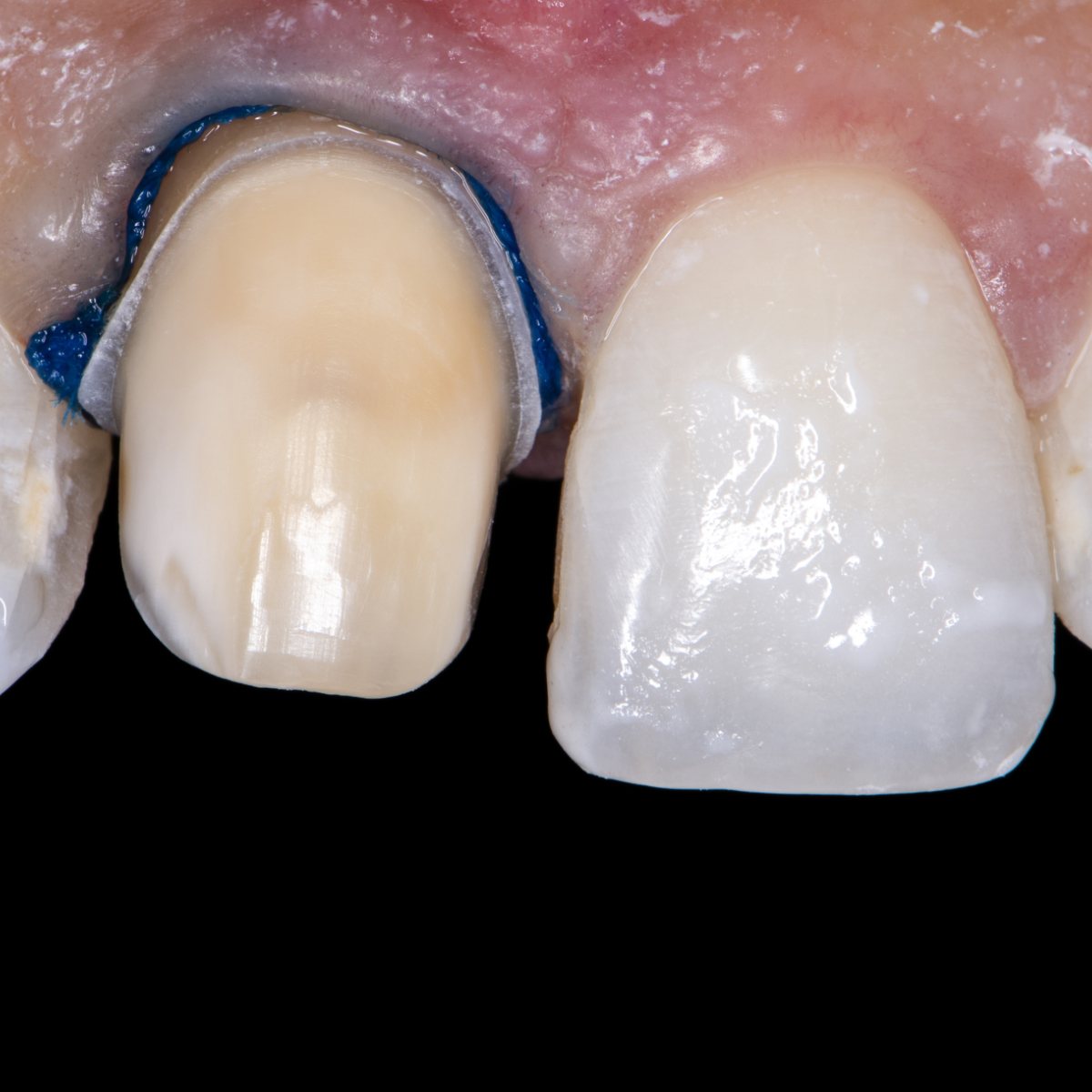 Keramikveneers in der Vorbereitung
