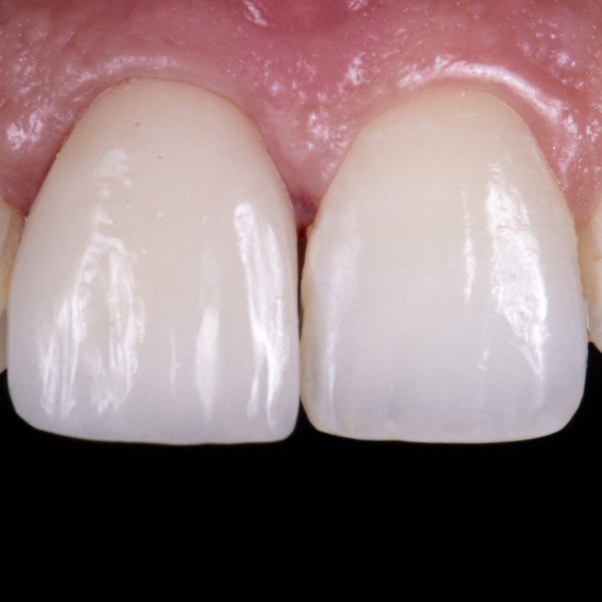 Frontzahn - wunderschönes, natürliches Keramik Veneer im Close up