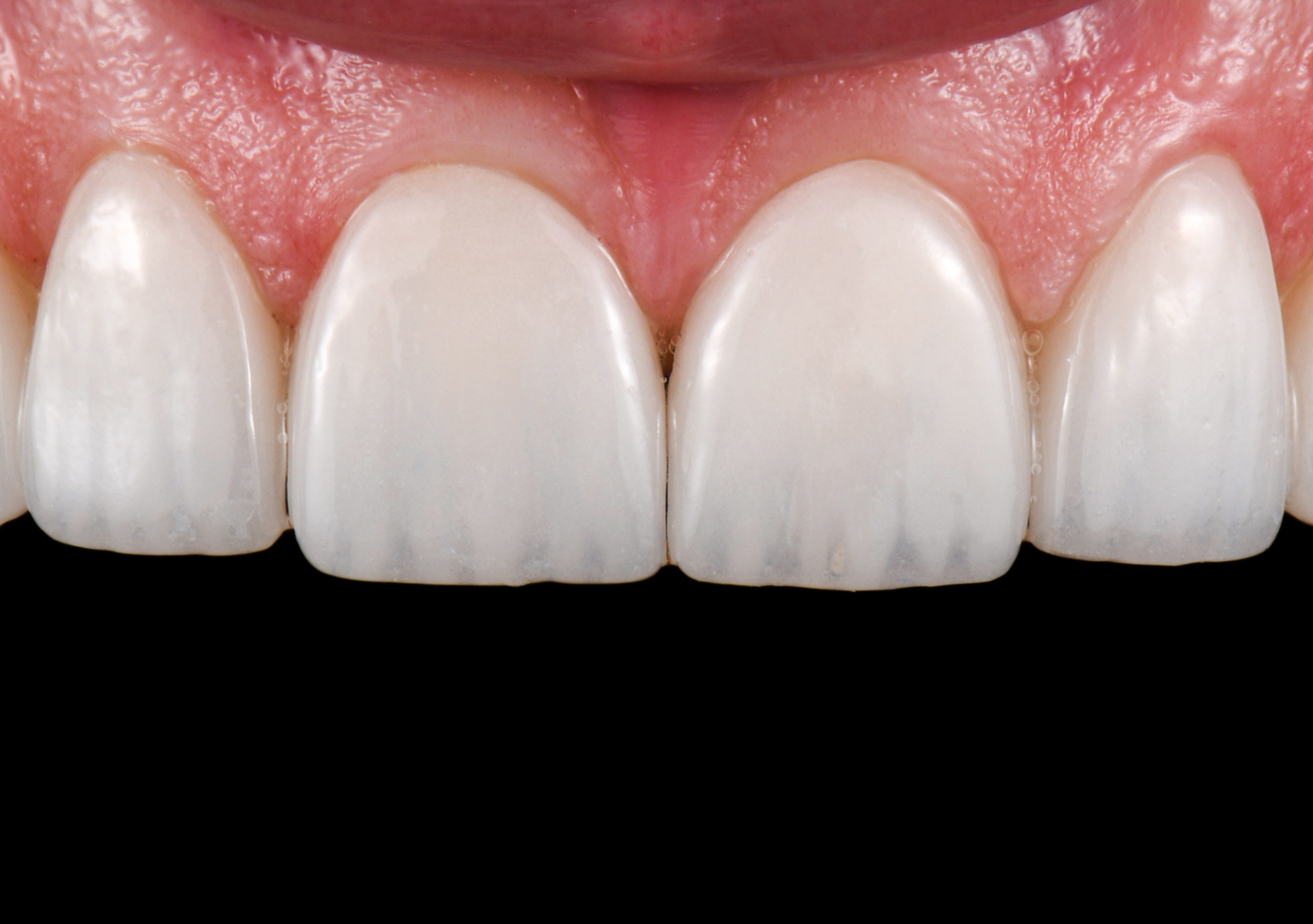 Frontzahnkorrektur mit Veneers - Close up