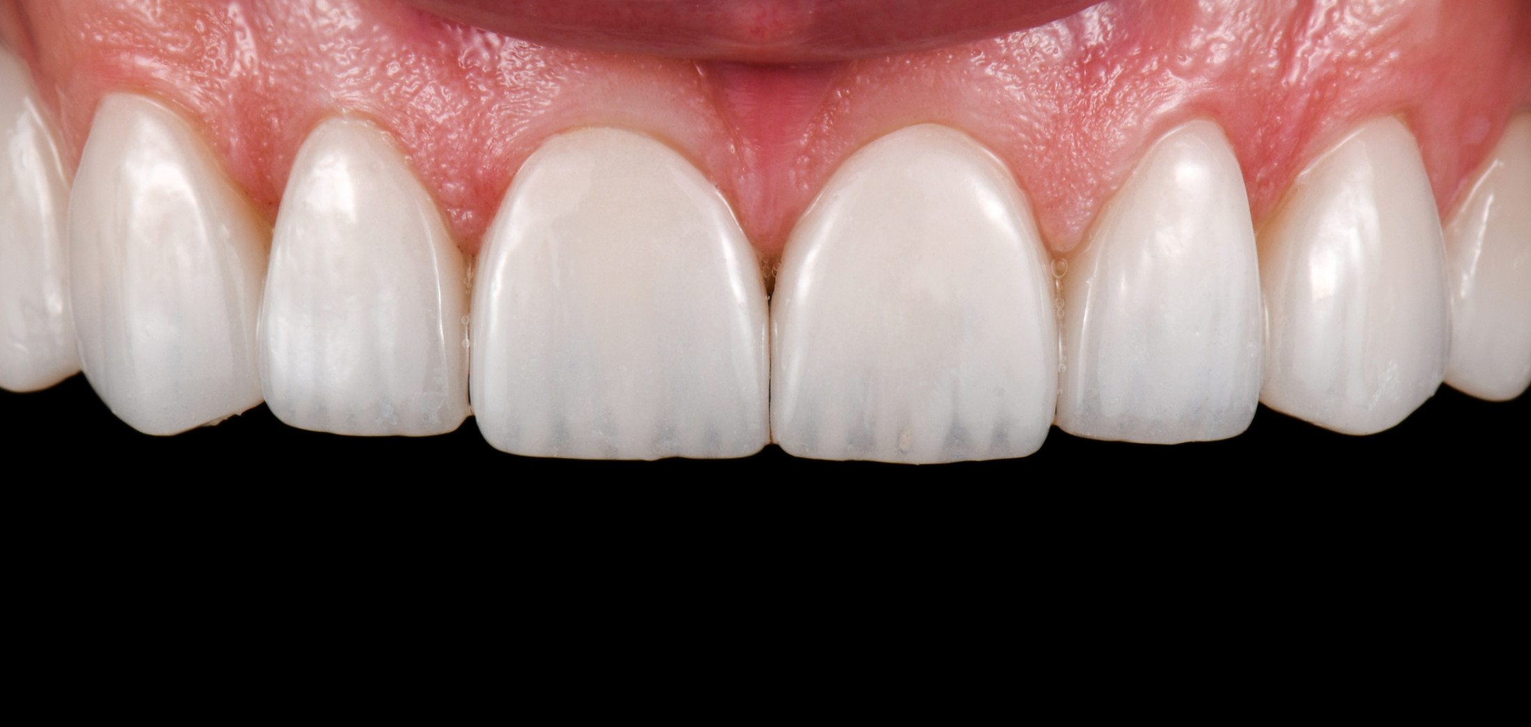 Frontzahnkorrektur mit wunderschönen Veneers