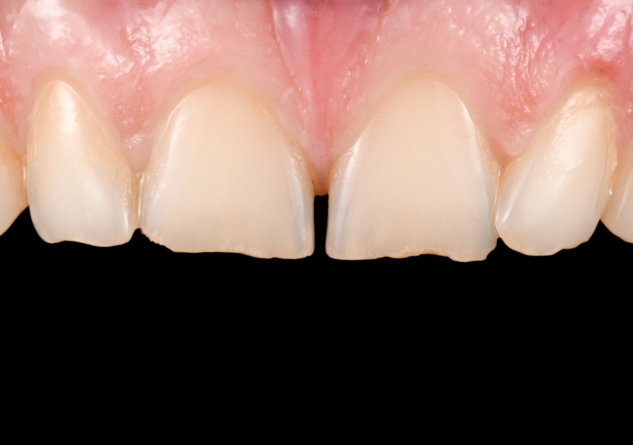 Keramik Veneers – Situation vorher im Close up