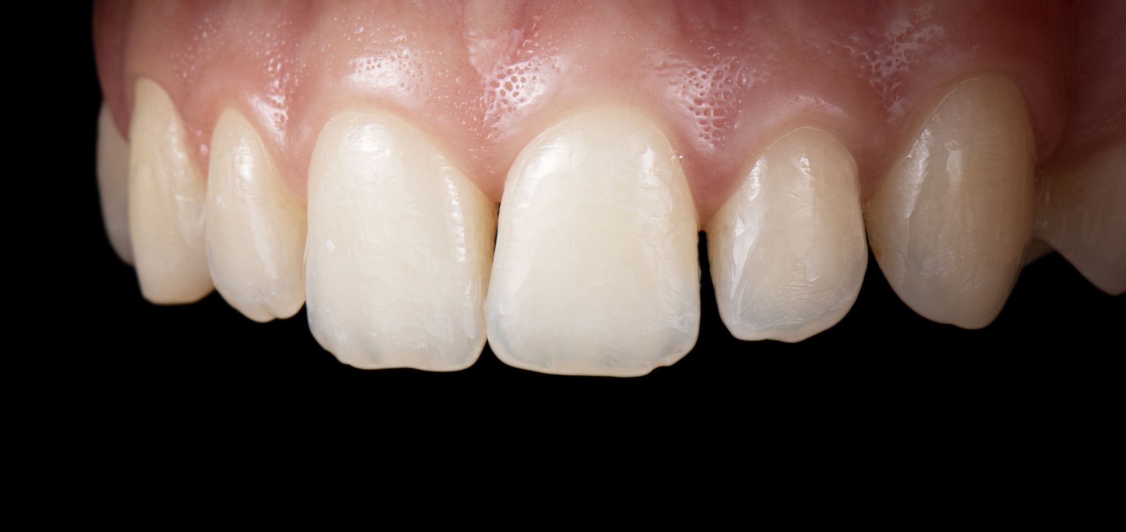 Frontzahn Korrektur mit Veneers – Ansicht vorher