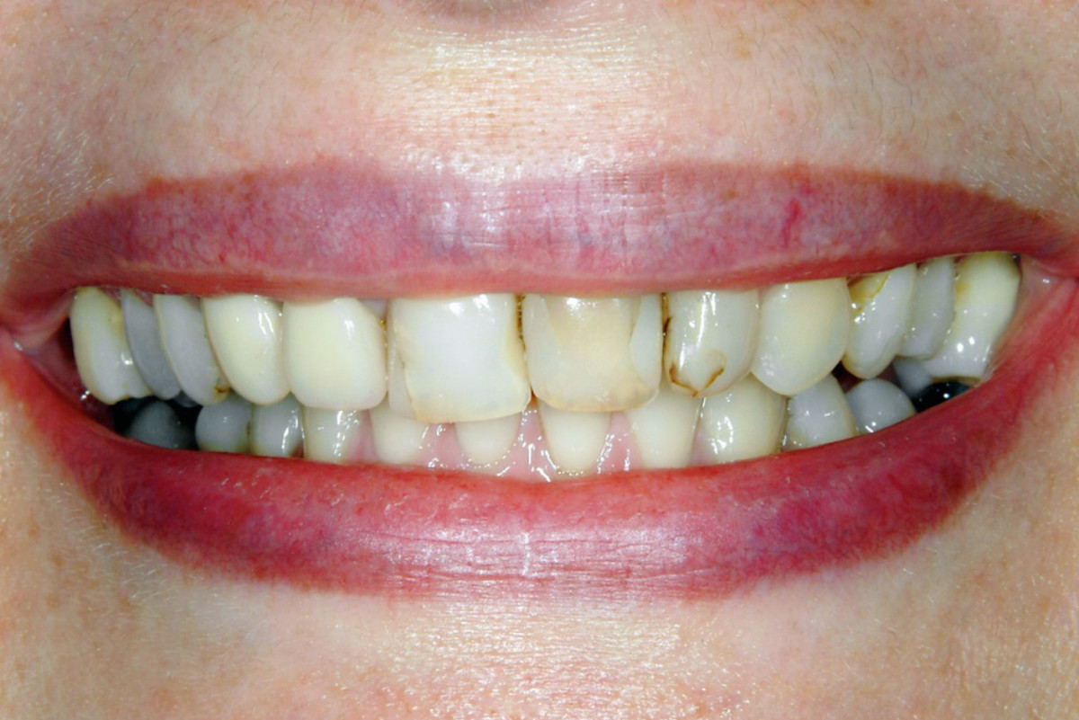 Gebisssanierung – schlechte Zähne