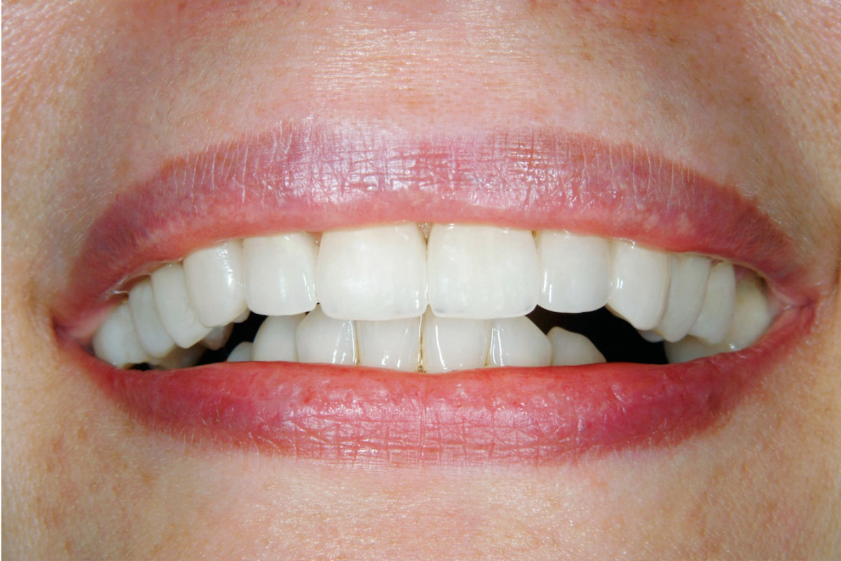 Gebisssanierung nach der Behandlung