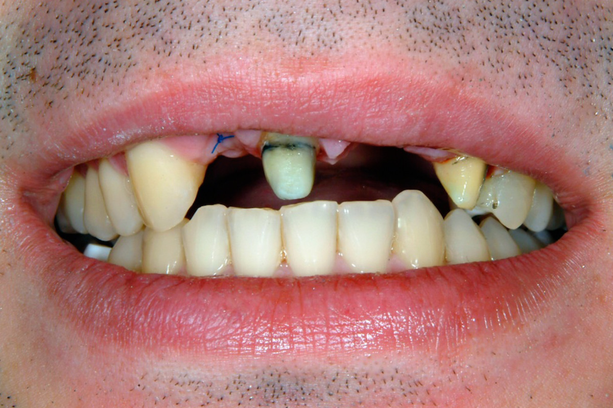 Vor der Gebissanierung Zahnarzt Arzberg