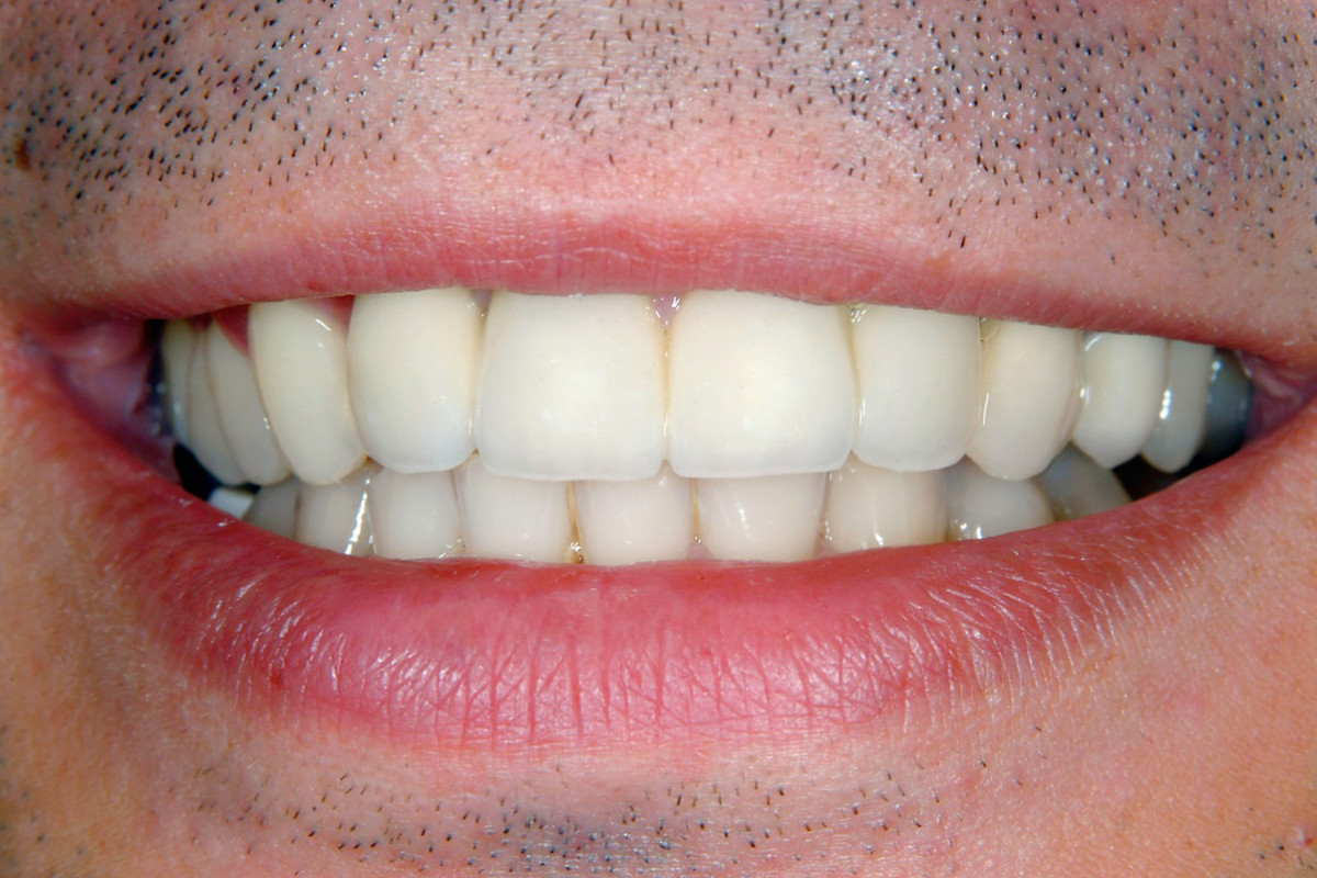 Nach der Gebissanierung Zahnarzt Arzberg