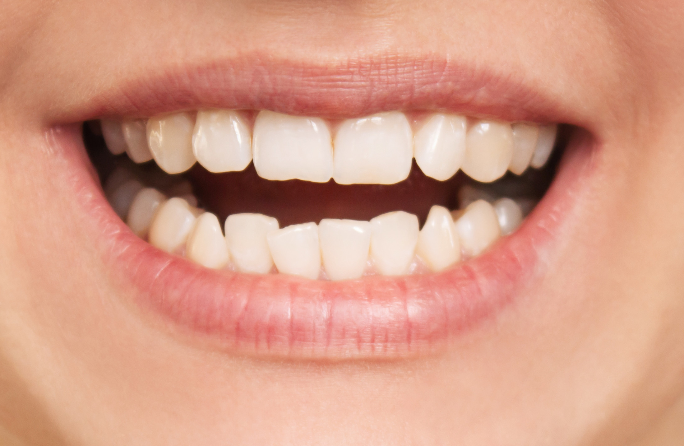 Zahnkorrektur mit Alignern – Mund mit schiefen Zähnen im Unterkiefer
