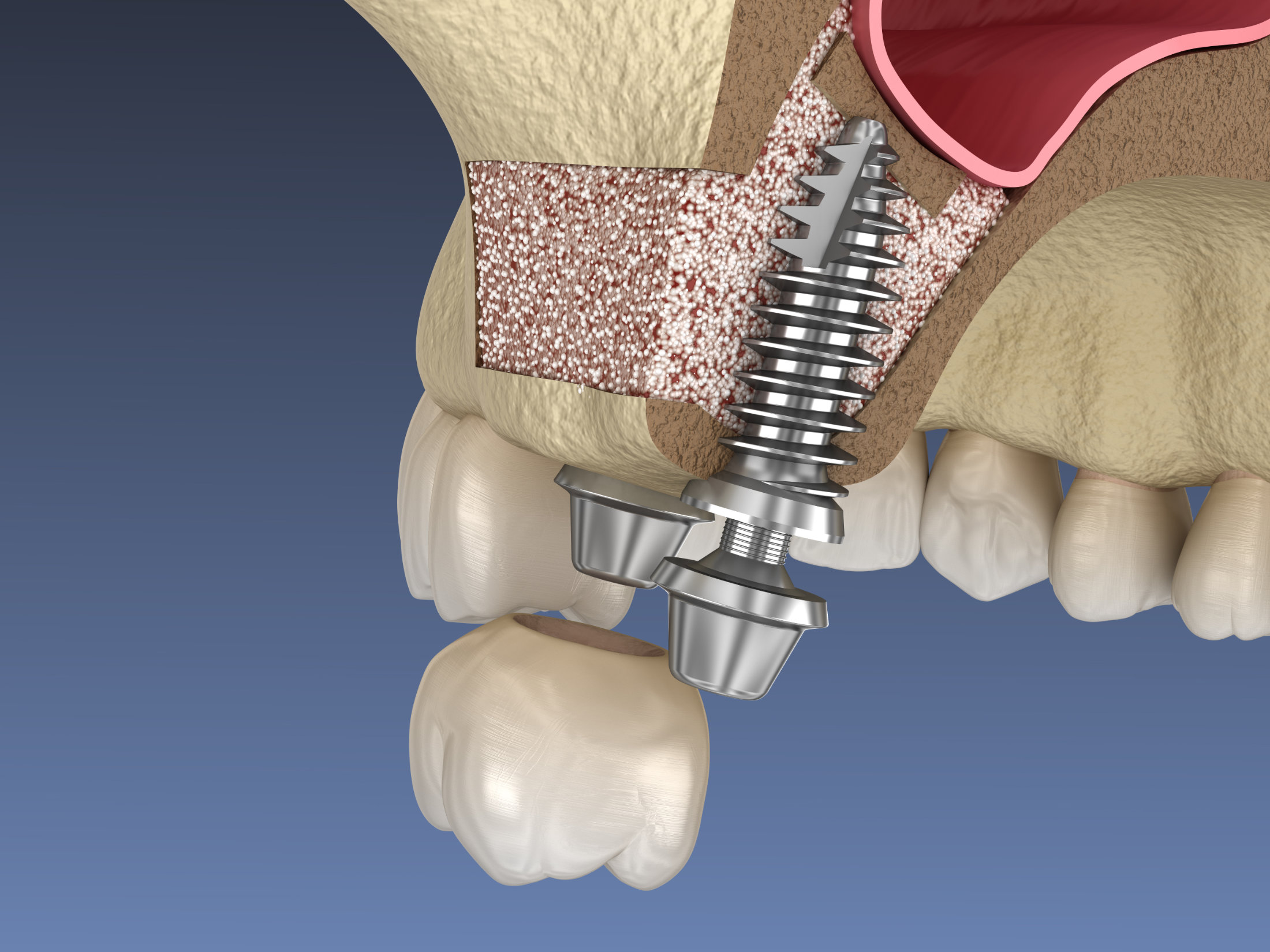 Sinuslift Rendering